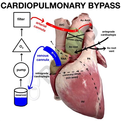 centrifugal pump in cardiopulmonary bypass|basics of cardiopulmonary bypass.